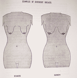 EXAMPLES OF DIVERGENT BREASTS